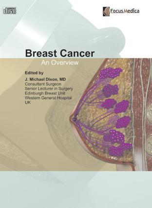 breast cancer